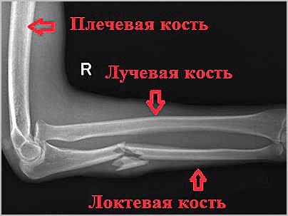 Причины, признаки и лечение перелома костей предплечья Причины, признаки и лечение перелома костей предплечья