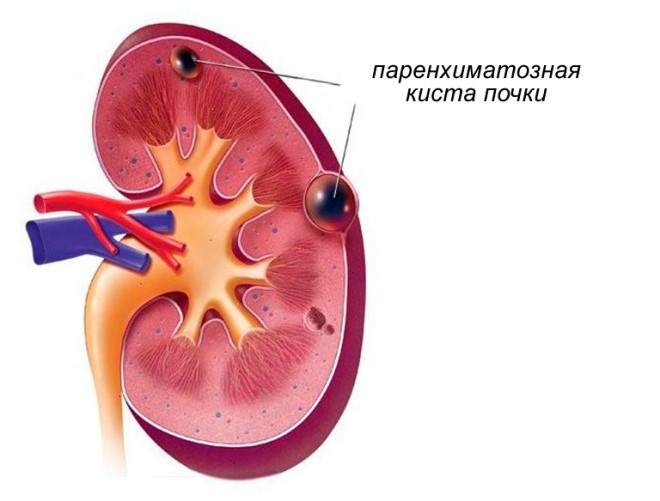Особенности паренхиматозной кисты почки Особенности паренхиматозной кисты почки