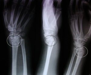 Виды и методы лечения переломов лучевой кости Виды и методы лечения переломов лучевой кости