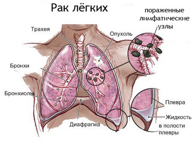 Лечение и симптомы рака легких 4 стадии Лечение и симптомы рака легких 4 стадии