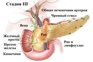 Причины, симптомы и лечение опухоли поджелудочной железы Причины, симптомы и лечение опухоли поджелудочной железы