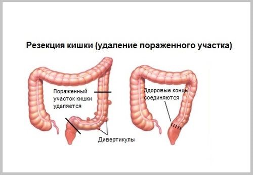 Стадии и симптомы рака сигмовидной кишки Стадии и симптомы рака сигмовидной кишки