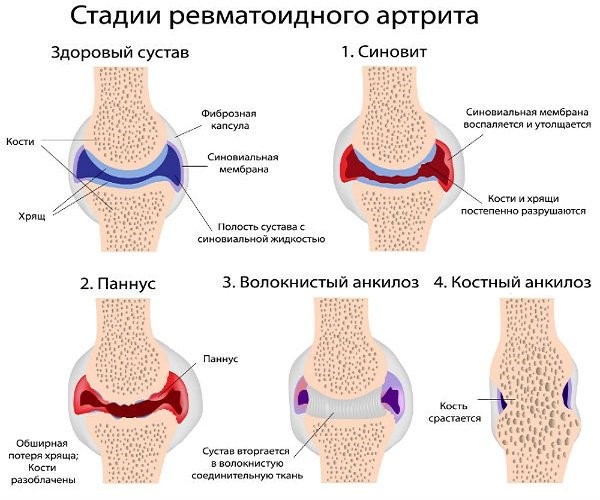 Полная характеристика ревматоидного артрита у детей: причины, симптомы, лечение Полная характеристика ревматоидного артрита у детей: причины, симптомы, лечение