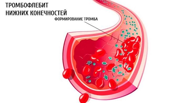 Особенности тромбофлебита поверхностных вен на ногах Особенности тромбофлебита поверхностных вен на ногах