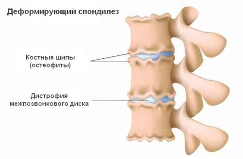 Спондилез крестцового отдела позвоночника Спондилез крестцового отдела позвоночника