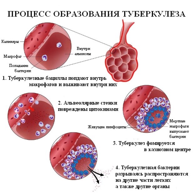 Туберкулема легких - что это такое и как выполнять лечение Туберкулема легких - что это такое и как выполнять лечение