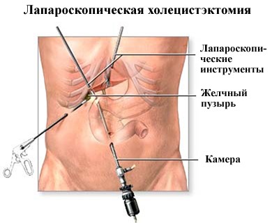 После удаления желчного пузыря проблемы с пищеварением После удаления желчного пузыря проблемы с пищеварением