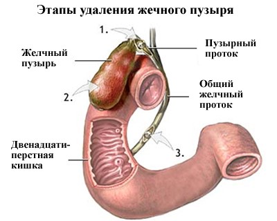 После удаления желчного пузыря проблемы с пищеварением После удаления желчного пузыря проблемы с пищеварением
