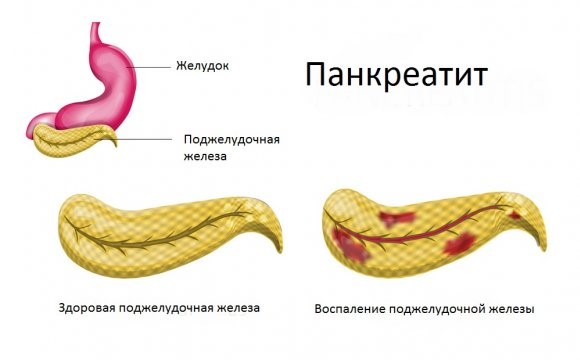 Что делать: понос и температура 38 у взрослого Что делать: понос и температура 38 у взрослого
