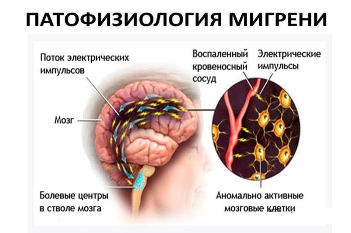 Болезни сосудов головного мозга Болезни сосудов головного мозга