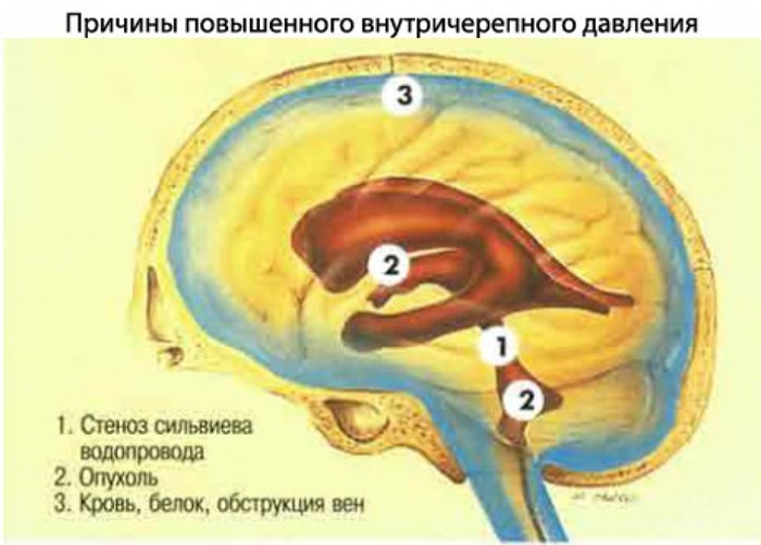 Болезни сосудов головного мозга Болезни сосудов головного мозга
